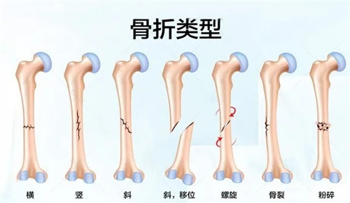 济南中德骨科骨折.jpg